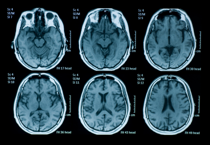 dual diagnosis